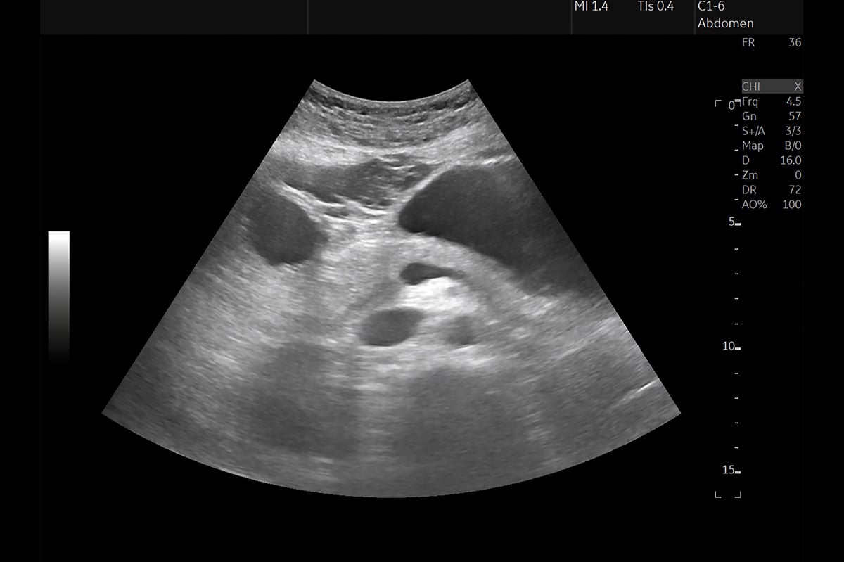 ultrasound image of the human abdomen, disease diagnosis and treatment concept. Ultrasound upper abdomen for diagnosis abdominal pain, kidney, pancreas.